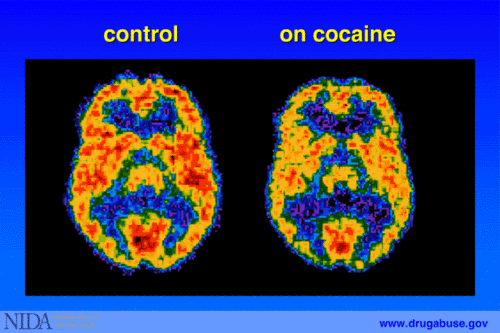 effects of drug addiction on the brain